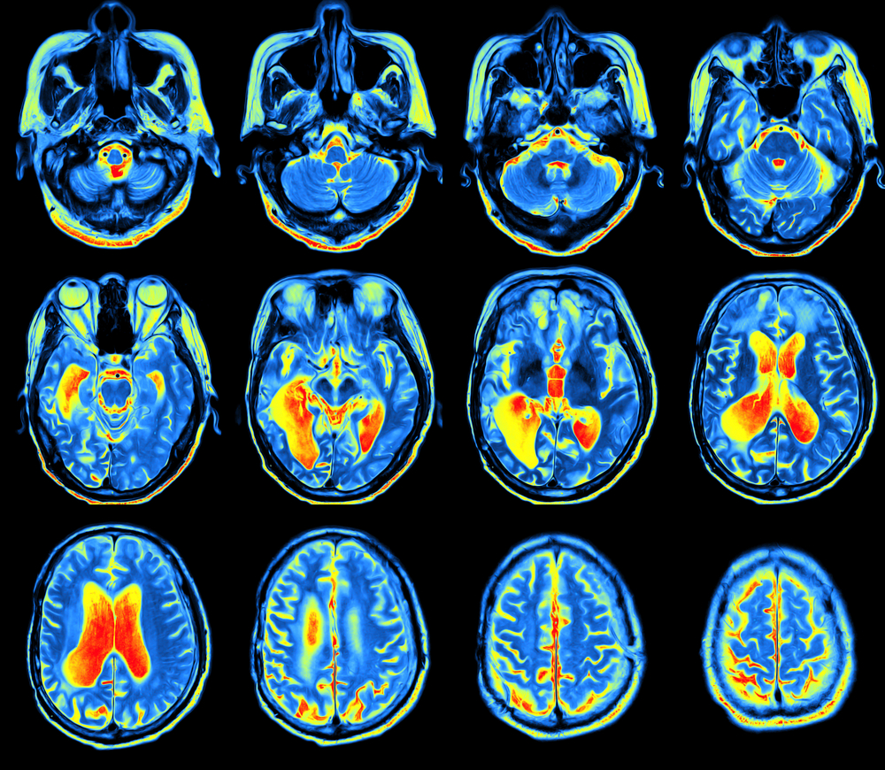 การสูญเสียหน่วยความจำแสดงใน MRI Scan