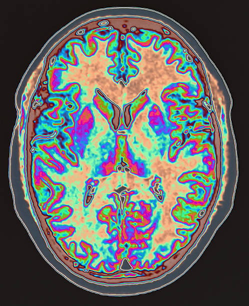 stages of dementia scan, brain scan