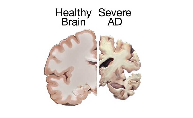 Gezonde hersenen vs. de ziekte van Alzheimer Hersenen